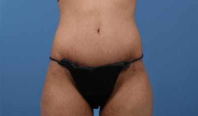 Tummy Tuck Before & After Gallery - Patient 150475 - Image 2
