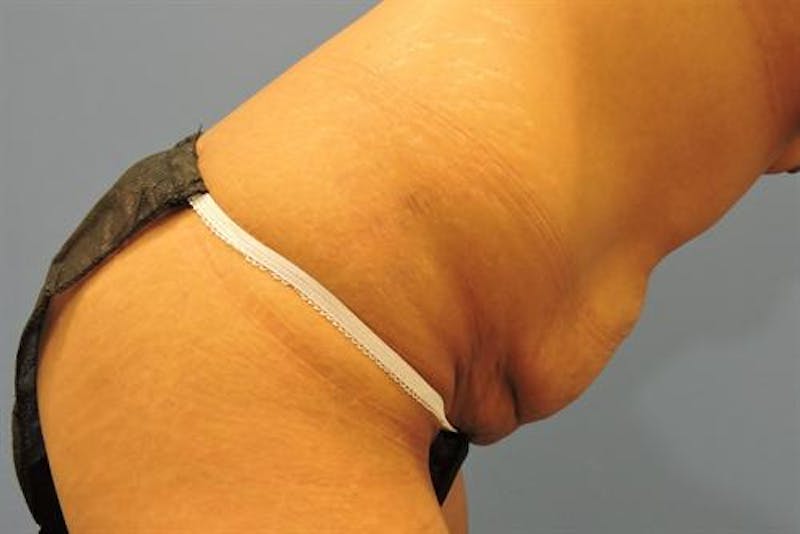 Tummy Tuck Before & After Gallery - Patient 150475 - Image 3