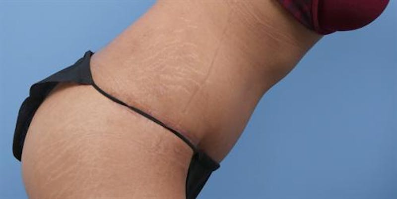 Tummy Tuck Before & After Gallery - Patient 150475 - Image 4