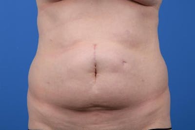 Tummy Tuck Before & After Gallery - Patient 322920 - Image 1