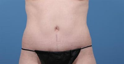 Tummy Tuck Before & After Gallery - Patient 322920 - Image 2