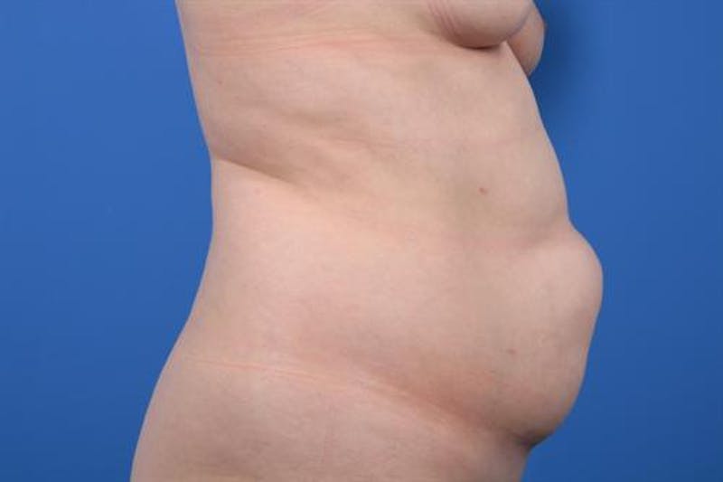 Tummy Tuck Before & After Gallery - Patient 322920 - Image 3