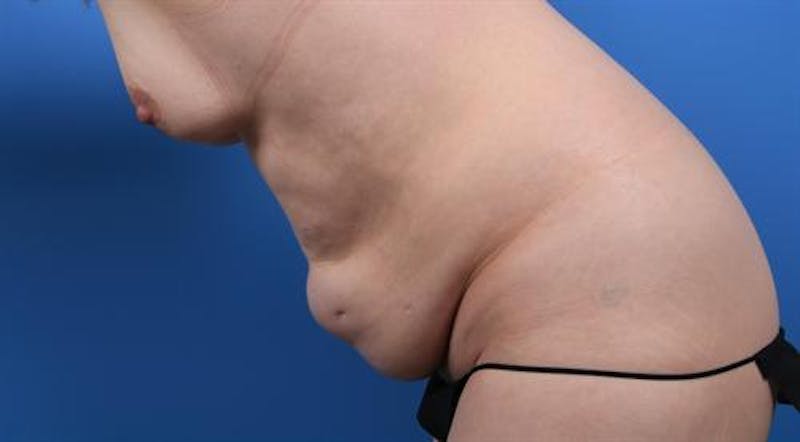 Tummy Tuck Before & After Gallery - Patient 322920 - Image 5