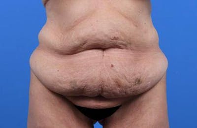 Tummy Tuck Before & After Gallery - Patient 374375 - Image 1
