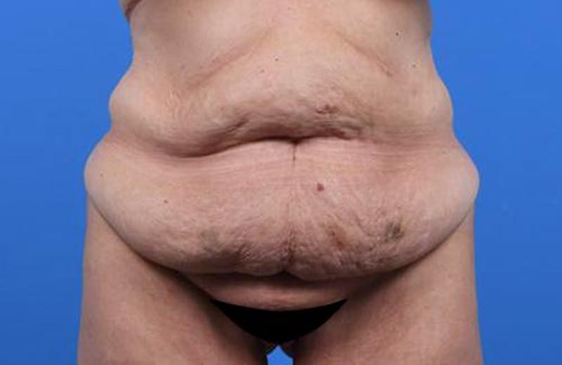 Tummy Tuck Before & After Gallery - Patient 374375 - Image 1