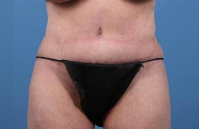 Tummy Tuck Before & After Gallery - Patient 374375 - Image 2