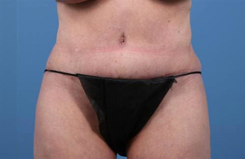 Tummy Tuck Before & After Gallery - Patient 374375 - Image 2