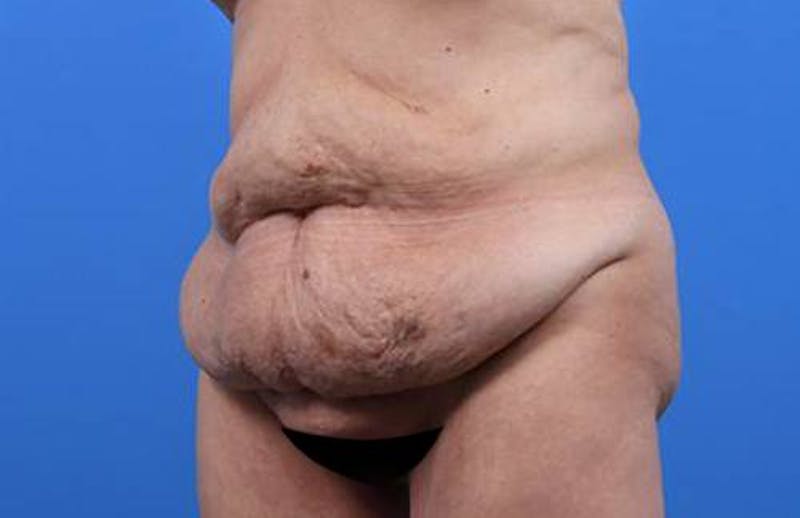 Tummy Tuck Before & After Gallery - Patient 374375 - Image 3
