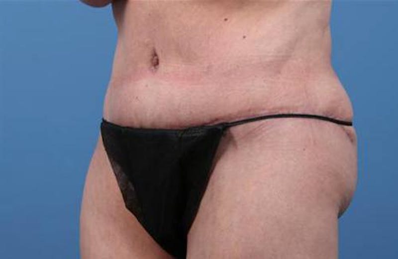 Tummy Tuck Before & After Gallery - Patient 374375 - Image 4
