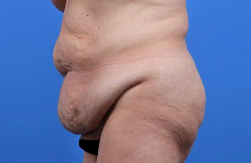 Tummy Tuck Before & After Gallery - Patient 374375 - Image 5