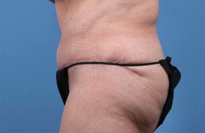 Tummy Tuck Before & After Gallery - Patient 374375 - Image 6