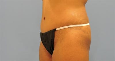 Tummy Tuck Before & After Gallery - Patient 116549 - Image 2