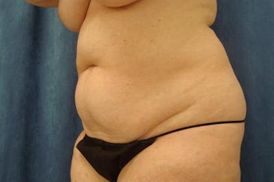 Tummy Tuck Before & After Gallery - Patient 369513 - Image 1