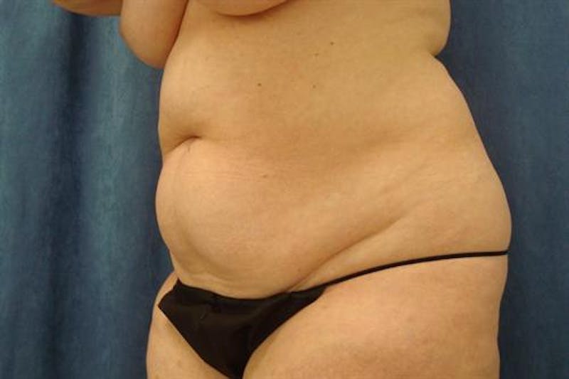Tummy Tuck Before & After Gallery - Patient 369513 - Image 1
