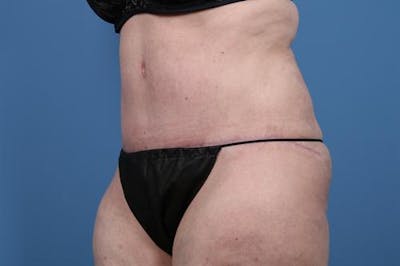 Tummy Tuck Before & After Gallery - Patient 369513 - Image 2