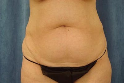 Tummy Tuck Before & After Gallery - Patient 218751 - Image 1