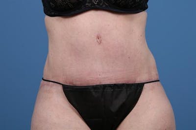 Tummy Tuck Before & After Gallery - Patient 218751 - Image 2