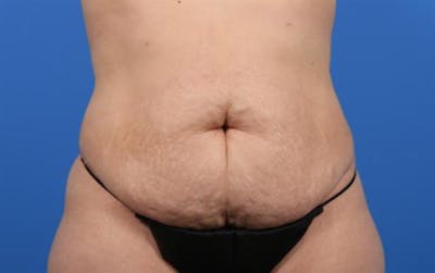 Tummy Tuck Before & After Gallery - Patient 394991 - Image 1