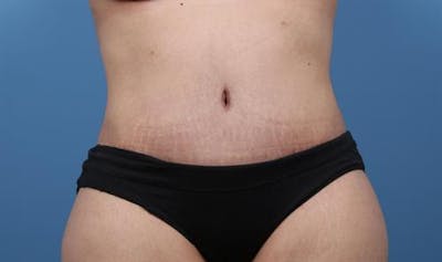 Tummy Tuck Before & After Gallery - Patient 394991 - Image 2