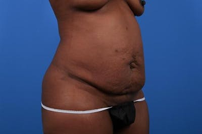 Tummy Tuck Before & After Gallery - Patient 313836 - Image 1