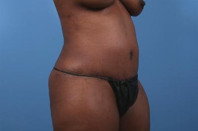 Tummy Tuck Before & After Gallery - Patient 313836 - Image 2