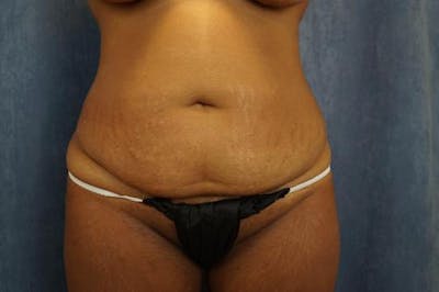 Tummy Tuck Before & After Gallery - Patient 343672 - Image 1