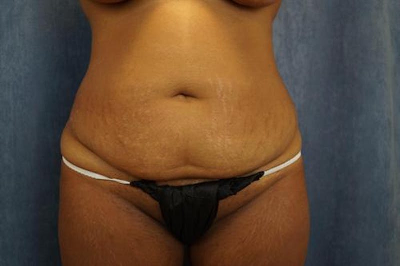 Tummy Tuck Before & After Gallery - Patient 343672 - Image 1