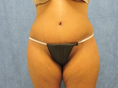 Tummy Tuck Before & After Gallery - Patient 343672 - Image 2