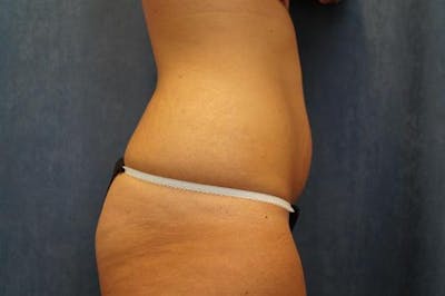 Tummy Tuck Before & After Gallery - Patient 998440 - Image 1