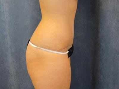 Tummy Tuck Before & After Gallery - Patient 998440 - Image 2