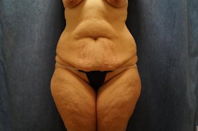 Tummy Tuck Before & After Gallery - Patient 825173 - Image 1