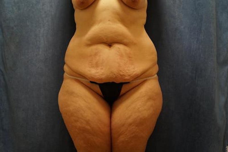 Tummy Tuck Before & After Gallery - Patient 825173 - Image 1