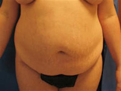 Tummy Tuck Before & After Gallery - Patient 296453 - Image 1