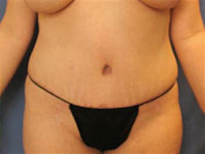 Tummy Tuck Before & After Gallery - Patient 296453 - Image 2
