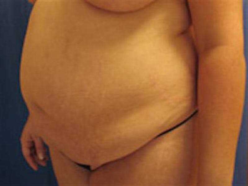 Tummy Tuck Before & After Gallery - Patient 296453 - Image 3