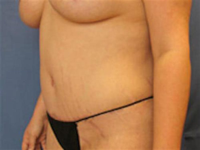 Tummy Tuck Before & After Gallery - Patient 296453 - Image 4