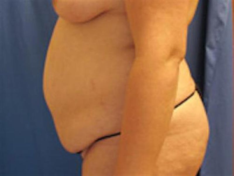Tummy Tuck Before & After Gallery - Patient 296453 - Image 5