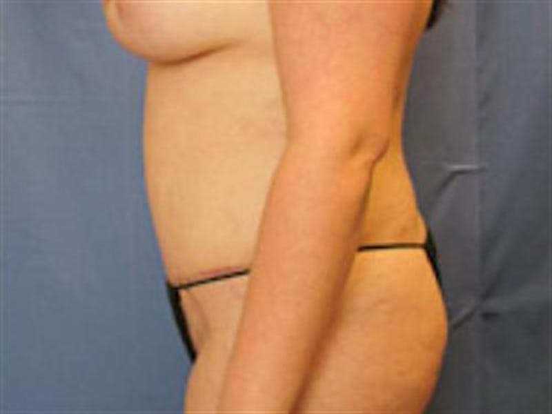 Tummy Tuck Before & After Gallery - Patient 296453 - Image 6
