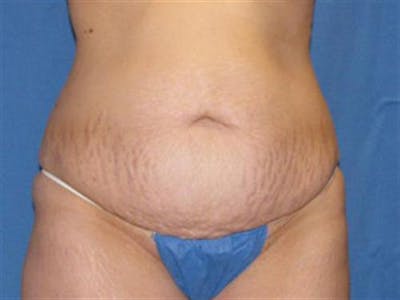 Tummy Tuck Before & After Gallery - Patient 150848 - Image 1