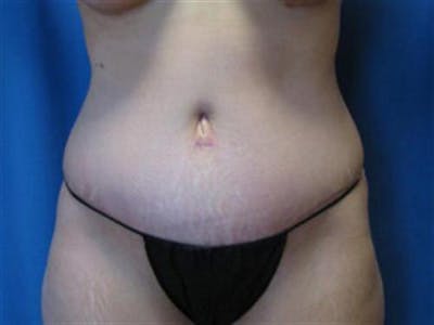 Tummy Tuck Before & After Gallery - Patient 150848 - Image 2
