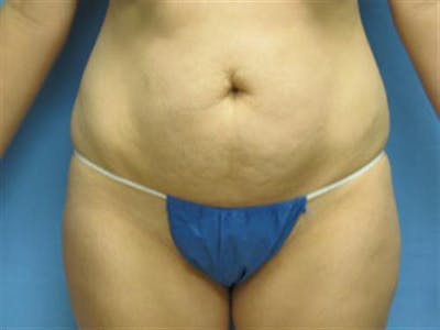 Tummy Tuck Before & After Gallery - Patient 699010 - Image 1