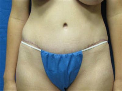 Tummy Tuck Before & After Gallery - Patient 699010 - Image 2