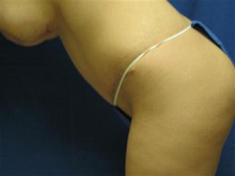 Tummy Tuck Before & After Gallery - Patient 699010 - Image 4