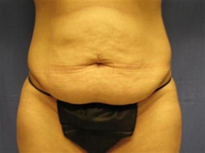 Tummy Tuck Before & After Gallery - Patient 747815 - Image 1
