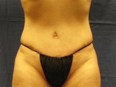 Tummy Tuck Before & After Gallery - Patient 747815 - Image 2