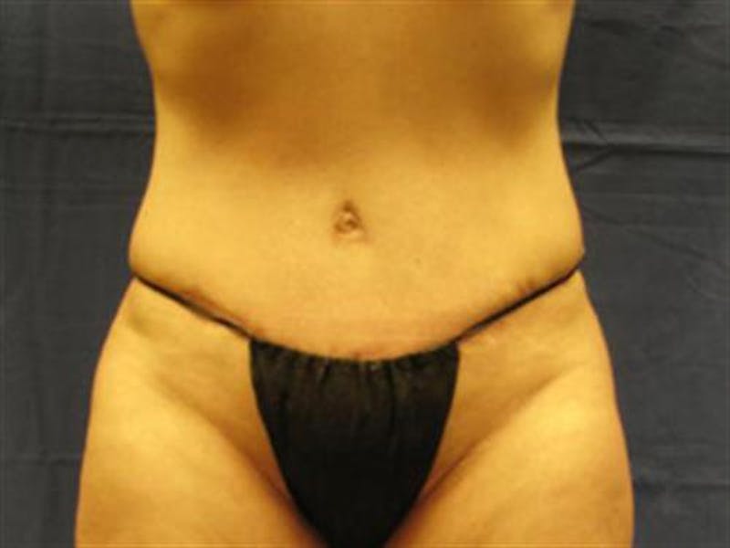 Tummy Tuck Before & After Gallery - Patient 747815 - Image 2