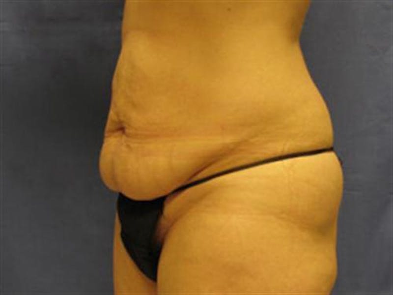 Tummy Tuck Before & After Gallery - Patient 747815 - Image 3