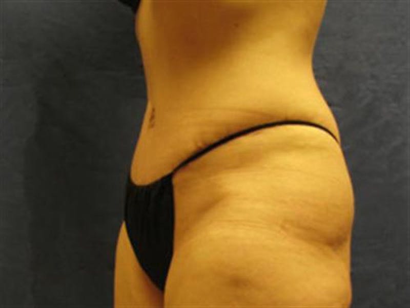 Tummy Tuck Before & After Gallery - Patient 747815 - Image 4