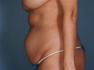 Tummy Tuck Before & After Gallery - Patient 138718 - Image 1