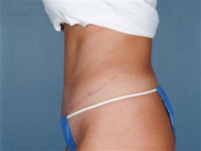 Tummy Tuck Before & After Gallery - Patient 138718 - Image 2
